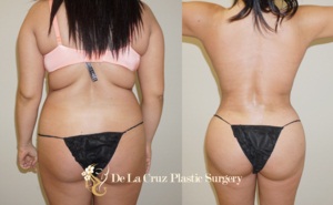 Houston_VASER_Liposuction_Beverly_Hills_Plastic_Surgeon.jpg